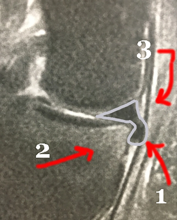 IRM : lésion instable du ménisque interne avec languette